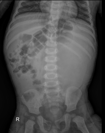 Wilms tumor | Radiology Case | Radiopaedia.org