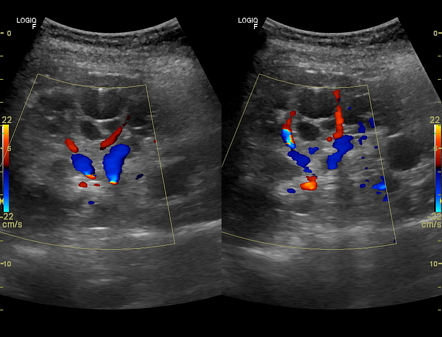 Adult polycystic kidney disease | Radiology Case | Radiopaedia.org