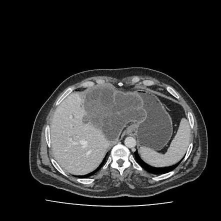 Hepatic hydatid cyst with intrabiliary rupture | Radiology Case ...