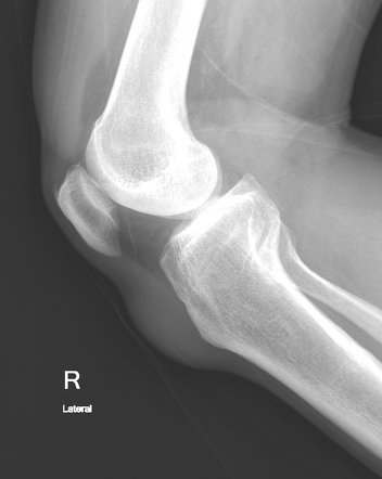 Superficial infrapatellar bursitis | Radiology Case | Radiopaedia.org