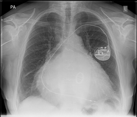 Mitral heart | Radiology Case | Radiopaedia.org