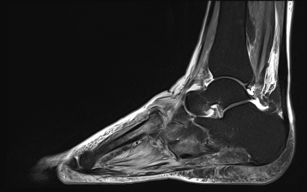 Neuropathic joint and diabetic myopathy | Radiology Case | Radiopaedia.org