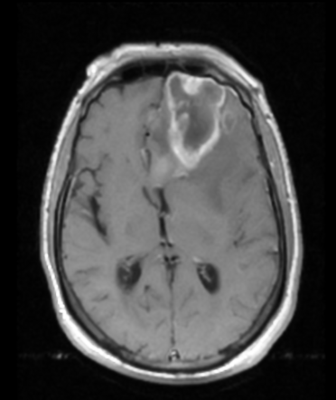 Glioblastoma | Radiology Case | Radiopaedia.org