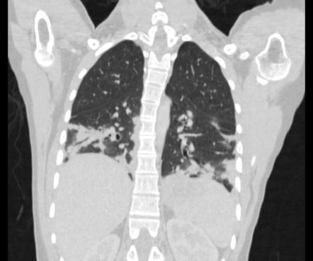 Featured image of post Radiopaedia Organising Pneumonia Read more about symptoms diagnosis treatment