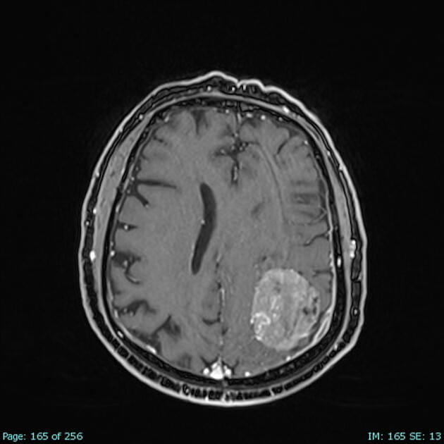 Meningioma | Radiology Reference Article | Radiopaedia.org