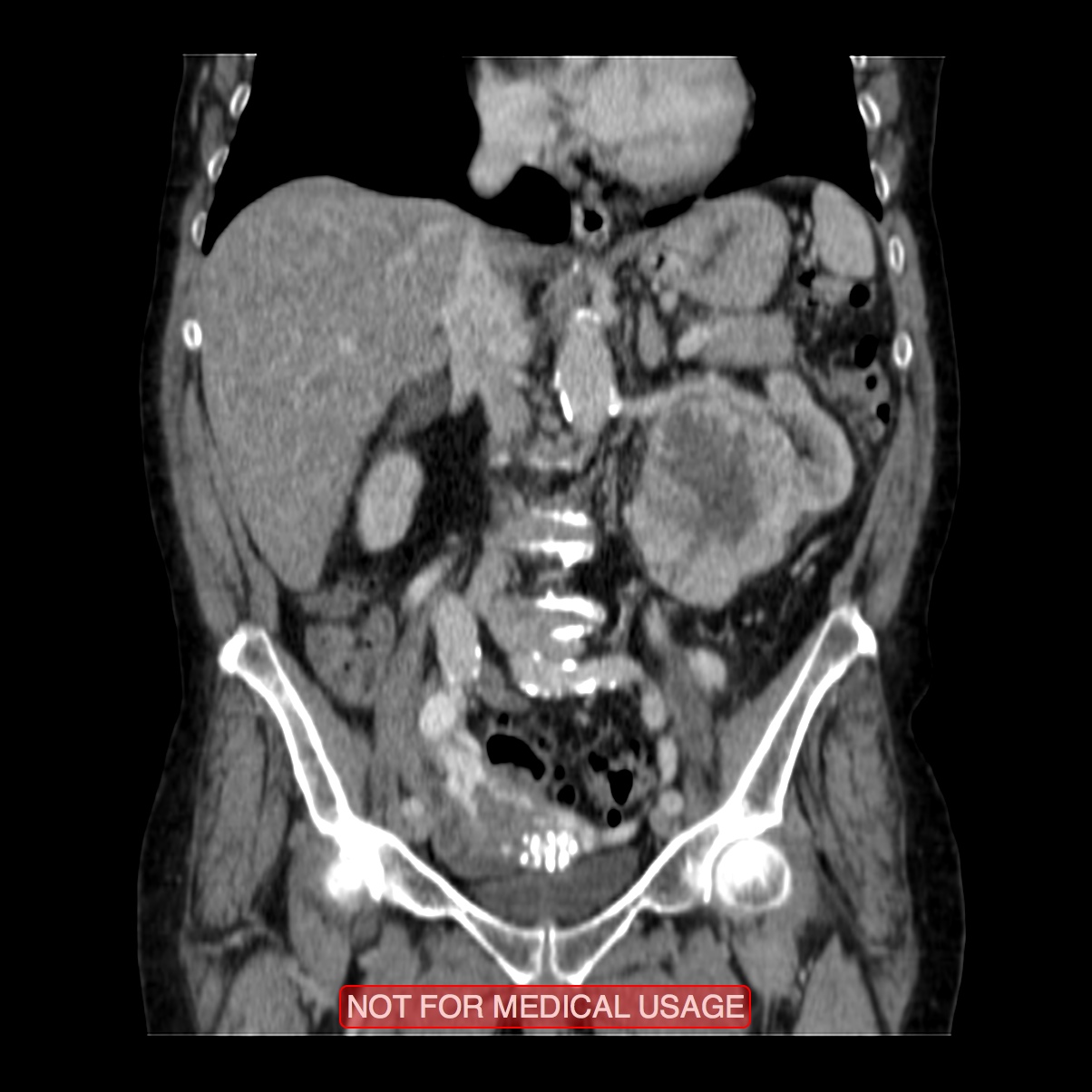 Clear Cell Renal Cell Carcinoma Image Radiopaedia Org