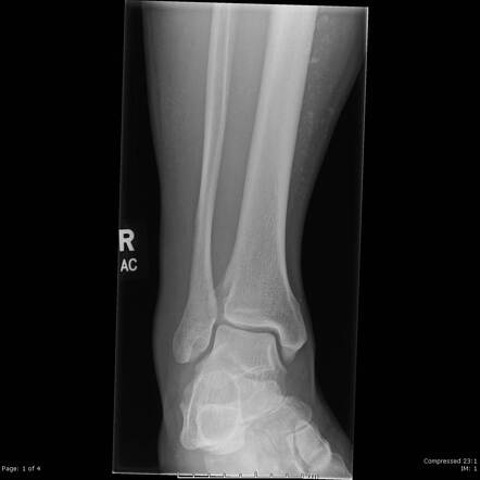 Chronic venous insufficiency | Radiology Case | Radiopaedia.org