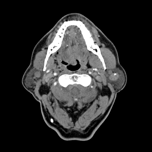 Warthin tumor with atypical calcification | Image | Radiopaedia.org