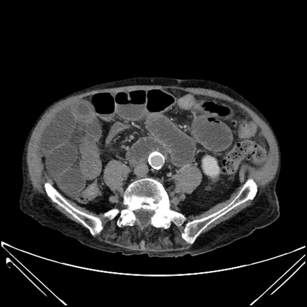 Closed loop SBO | Radiology Case | Radiopaedia.org