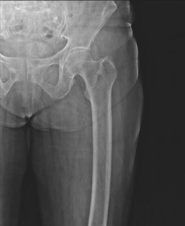 Soft tissue hematoma - thigh | Image | Radiopaedia.org