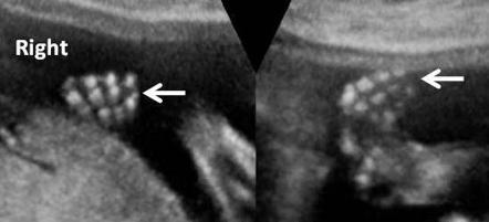 Rubinstein-Taybi syndrome  Radiology Reference Article