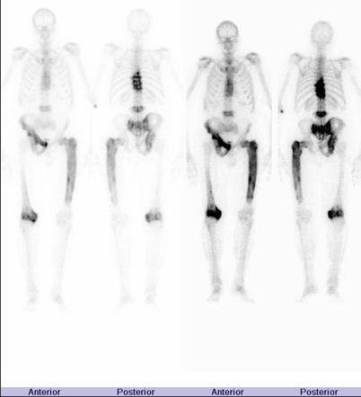 Paget Disease Bone Radiology Reference Article Radiopaedia Org