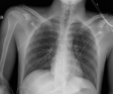 Normal anterior-posterior chest radiograph | Radiology Case ...