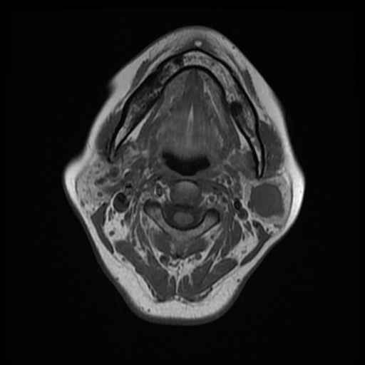 Pleomorphic Adenoma Image 