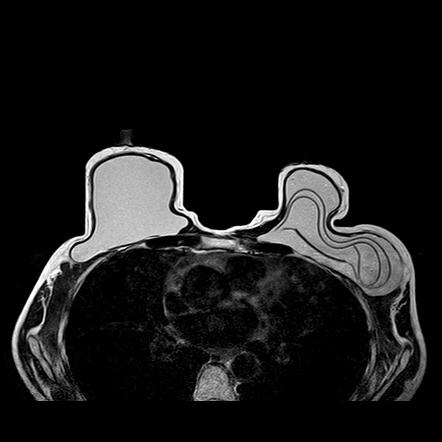 Intracapsular breast implant rupture | Radiology Case | Radiopaedia.org