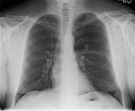 Bronchial atresia (VQ scan) | Radiology Case | Radiopaedia.org