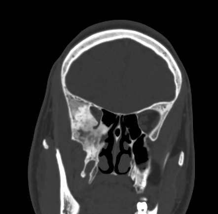 Fibrous dysplasia - sphenoid bone | Radiology Case | Radiopaedia.org