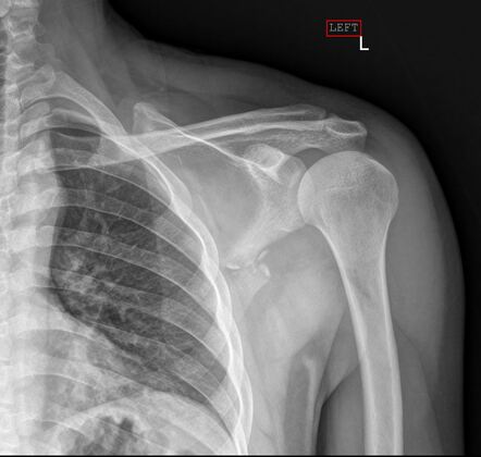 Scapula comminuted fracture | Radiology Case | Radiopaedia.org