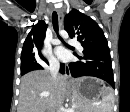 Scimitar syndrome | Radiology Case | Radiopaedia.org