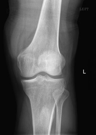 Segond fracture | Radiology Case | Radiopaedia.org