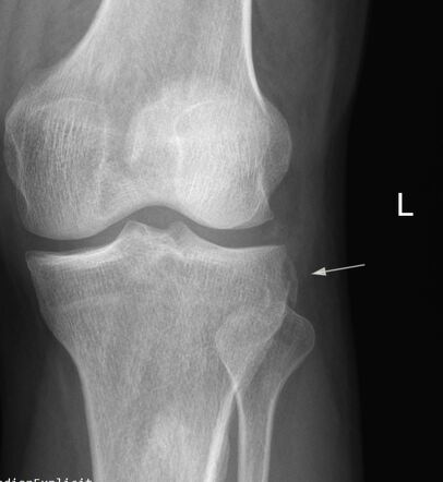 Segond fracture | Radiology Reference Article | Radiopaedia.org