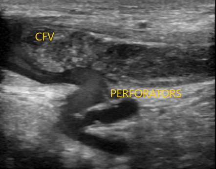 case study 4 deep venous thrombosis