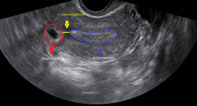 Ectopic pregnancy - Wikipedia