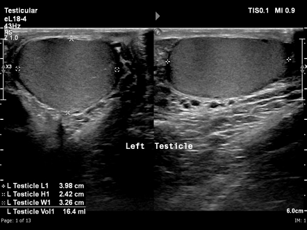 Unilateral Testicular Atrophy Radiology Case Radiopaedia Org