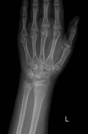 Os triangulare | Radiology Reference Article | Radiopaedia.org