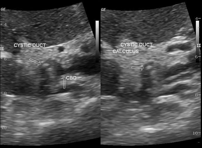 Cystic duct calculus | Image | Radiopaedia.org