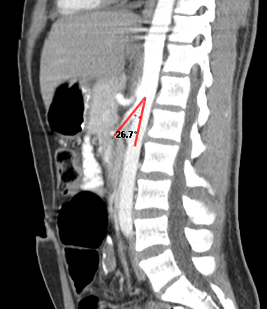 Nutcracker phenomenon | Radiology Case | Radiopaedia.org