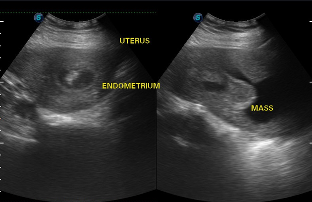 chorionic villi ultrasound