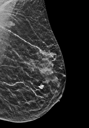 Female breast cancer | Radiology Case | Radiopaedia.org