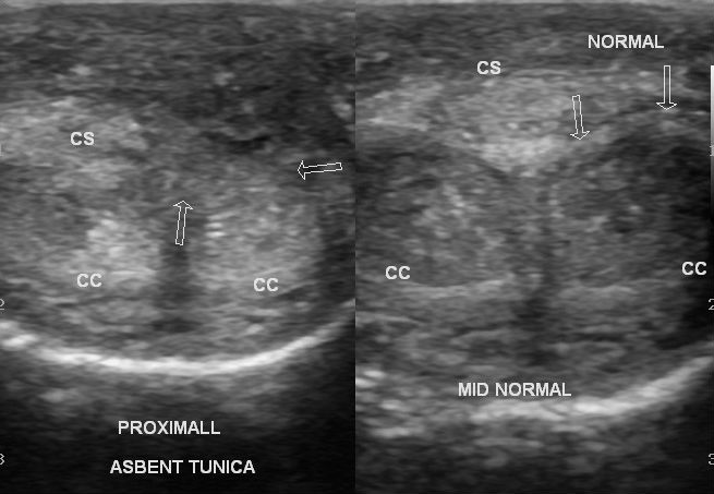 Penile Fracture | Image | Radiopaedia.org