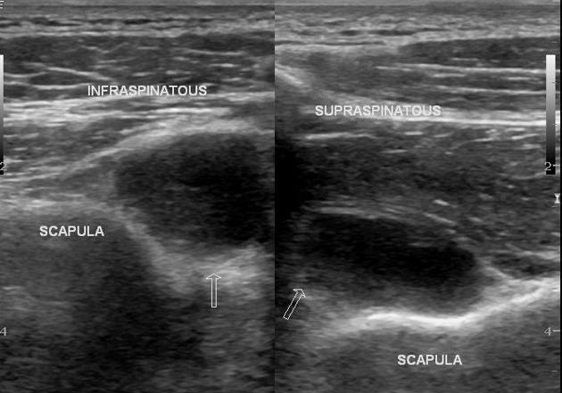 Paralabral Cyst Of Shoulder Radiology Case Radiopaedia Org