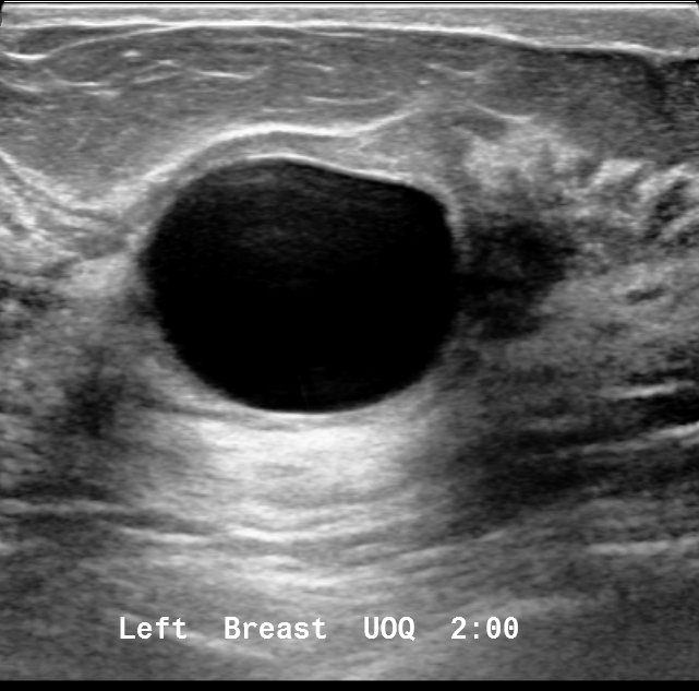 Simple breast cyst Image