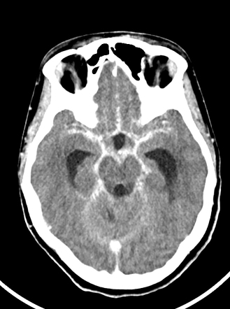 Tuberculous meningitis | Radiology Case | Radiopaedia.org