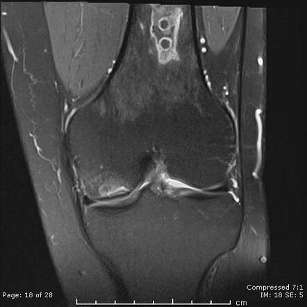 Sickle cell anemia - multifocal osteonecrosis | Radiology Case ...