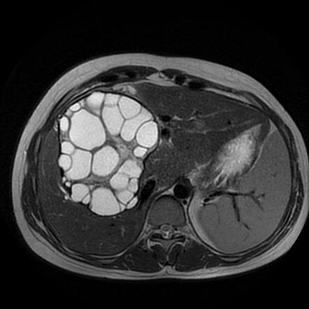 Hepatic hydatid cysts with cystobiliary communication | Radiology Case ...