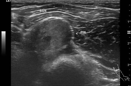 Peripheral nerve sheath tumour (elbow) | Radiology Case | Radiopaedia.org