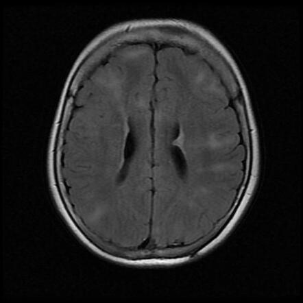 Tuberous sclerosis | Radiology Case | Radiopaedia.org