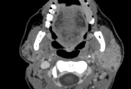 lymphoepithelial lesions parotid benign cystic radiopaedia cysts radiology hiv hyperplasia glands