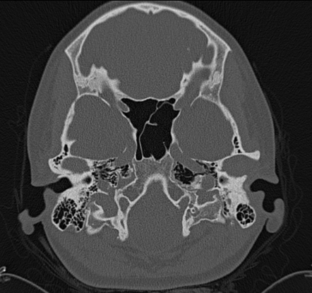 External auditory canal osteoma | Radiology Case | Radiopaedia.org