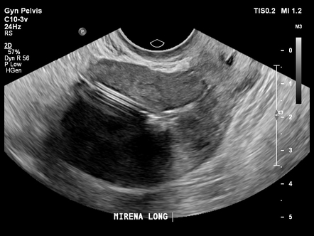 IUCD perforation | Radiology Case | Radiopaedia.org