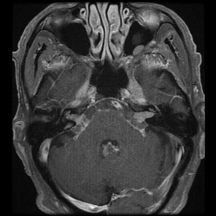 Perineural tumor spread from parotid adenoid cystic carcinoma ...