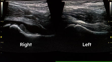 Hip joint septic arthritis | Radiology Case | Radiopaedia.org