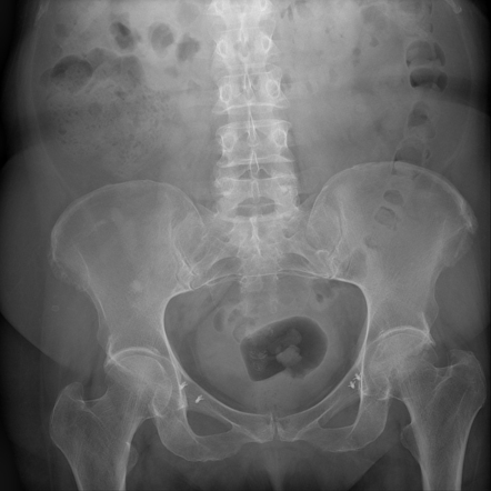 Tissue bone anchors in pelvic suspension(sling) surgery | Radiology ...