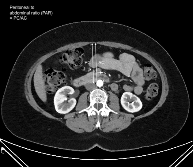 Compartment Syndrome - Physiopedia