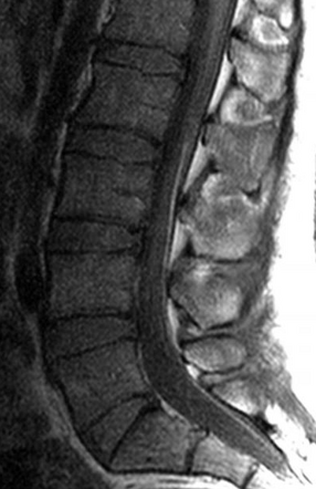 Filum Terminale Lipoma