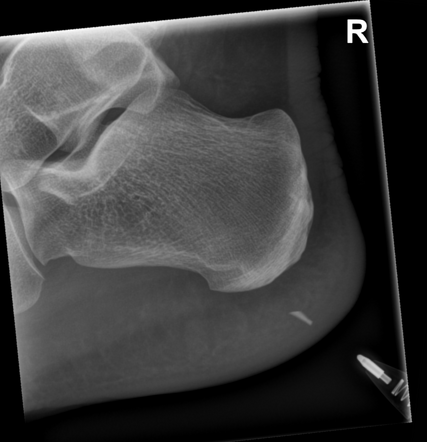 Glass foreign body - heel | Radiology Case | Radiopaedia.org